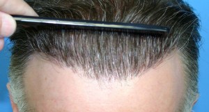 hair-transplant